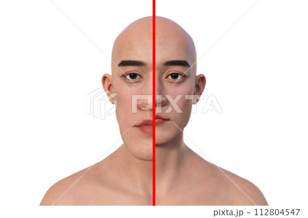 Acromegaly in a man, and the same healthy man, 3D illustration 112804547