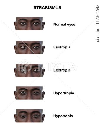 A man with various strabismus types, 3D illustration 112804548