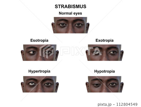A man with various strabismus types, 3D illustration 112804549