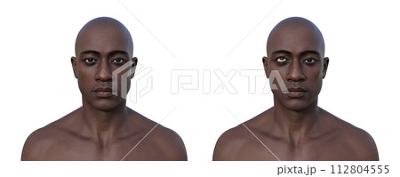 A man with hypertropia and a healthy man, 3D illustration A man with hypertropia and a healthy man, 3D illustration 112804555