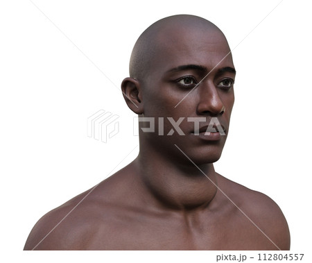 A man with enlarged thyroid gland, 3D illustration A man with enlarged thyroid gland, 3D illustration 112804557