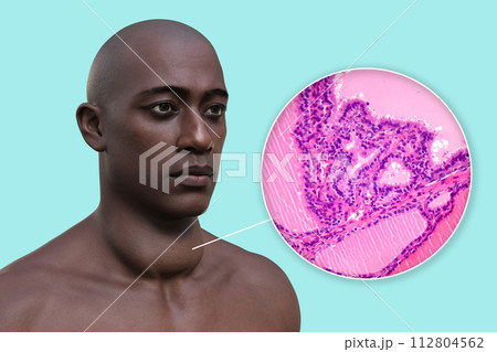 A man with enlarged thyroid gland, 3D illustration, and micrograph toxic goiter A man with enlarged thyroid gland, 3D illustration, and micrograph toxic goiter 112804562