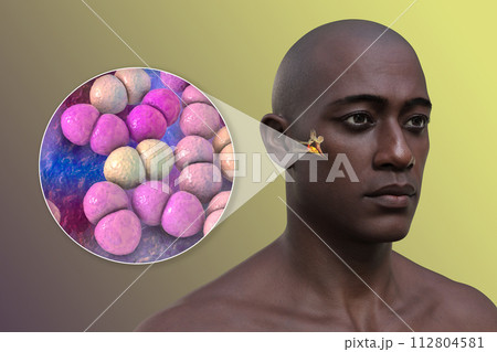 Otitis media ear infection, 3D illustration 112804581
