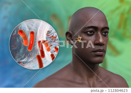 Otitis media ear infection, 3D illustration Otitis media ear infection, 3D illustration 112804623