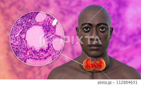 A man with enlarged thyroid gland, 3D illustration, and micrograph toxic goiter A man with enlarged thyroid gland, 3D illustration, and micrograph toxic goiter 112804631