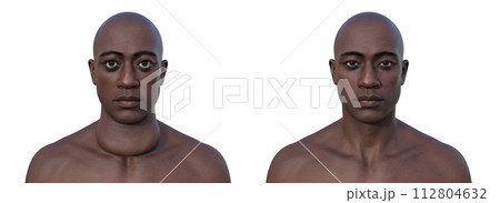 A man with enlarged thyroid gland, 3D illustration 112804632