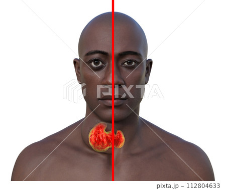 A man with enlarged thyroid gland, 3D illustration A man with enlarged thyroid gland, 3D illustration 112804633