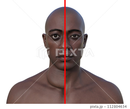 A man with enlarged thyroid gland, 3D illustration A man with enlarged thyroid gland, 3D illustration 112804634