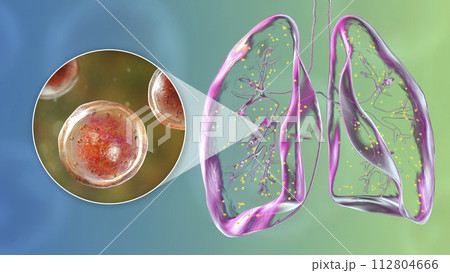 Lung adiaspiromycosis and close-up view of Emmonsia fungi, 3D illustration 112804666