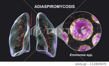Lung adiaspiromycosis and close-up view of Emmonsia fungi, 3D illustration 112804670