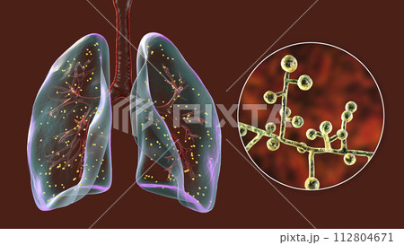 Lung adiaspiromycosis and close-up view of Emmonsia fungi, 3D illustration 112804671