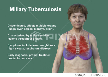 A female patient with lungs affected by miliary tuberculosis, 3D illustration 112805129