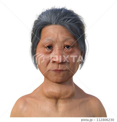 A woman with Graves' disease, 3D illustration A woman with Graves' disease, 3D illustration 112806230