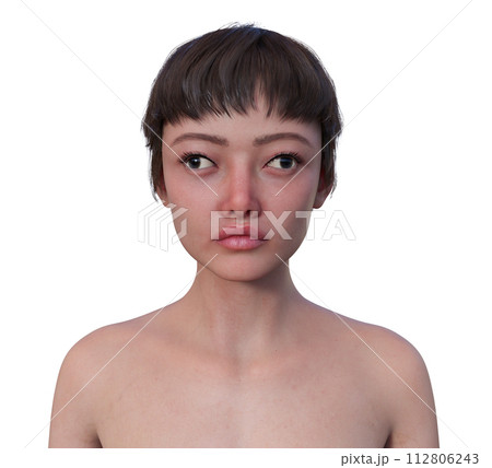A woman with exotropia, 3D illustration A woman with exotropia, 3D illustration 112806243