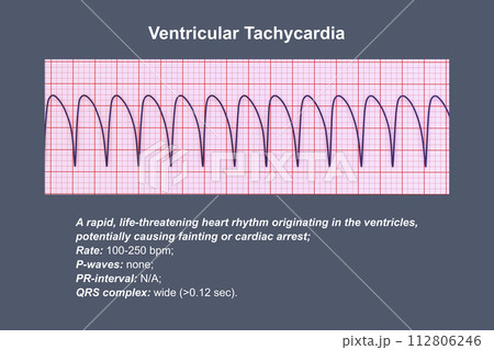 ECG in ventricular tachycardia, 3D illustration. 112806246