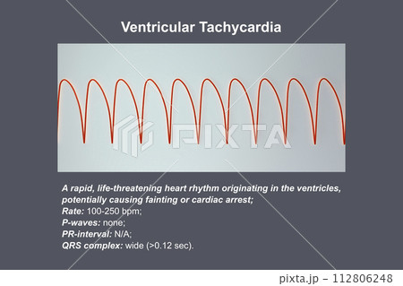 ECG in ventricular tachycardia, 3D illustration. 112806248