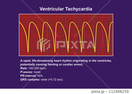 ECG in ventricular tachycardia, 3D illustration. 112806250