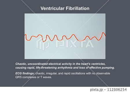 ECG displaying the chaotic rhythm of ventricular fibrillation, 3D illustration 112806254