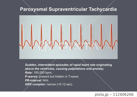 ECG in supraventricular tachycardia, 3D illustration 112806266