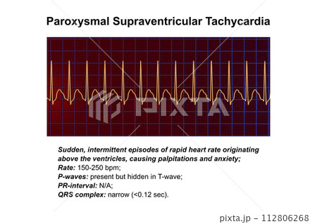 ECG in supraventricular tachycardia, 3D illustration ECG in supraventricular tachycardia, 3D illustration 112806268