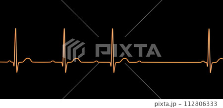 An ECG with 2nd degree AV block, 3D illustration 112806333
