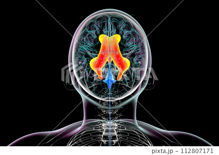 Enlarged lateral and third ventricles of the brain, 3D illustration Enlarged lateral and third ventricles of the brain, 3D illustration 112807171