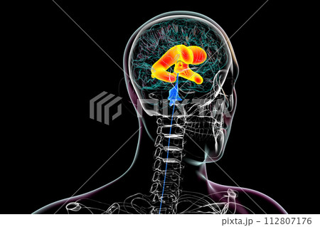 Enlarged lateral and third ventricles of the brain, 3D illustration 112807176