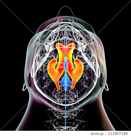 Enlarged lateral ventricles of the brain, 3D illustration 112807186