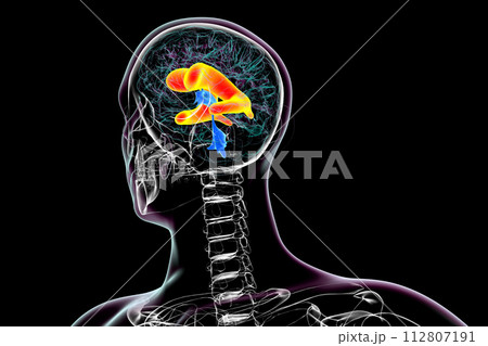 Enlarged lateral ventricles of the brain, 3D illustration 112807191