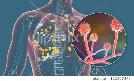 Lung histoplasmosis, a fungal infection caused by Histoplasma capsulatum, 3D illustration 112807373