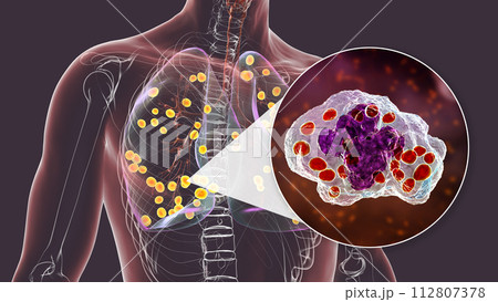 Lung histoplasmosis, a fungal infection caused by Histoplasma capsulatum, 3D illustration 112807378