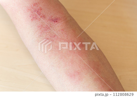 帯状疱疹 112808629