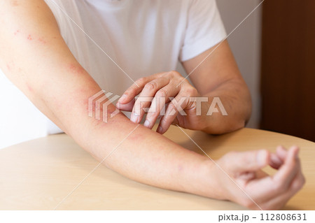 帯状疱疹 帯状疱疹 112808631