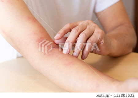 帯状疱疹 112808632