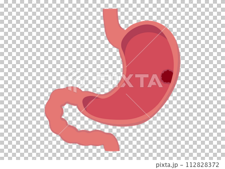 Stomach with gastric cancer tumor 112828372