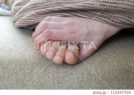 Dry cracked skin of woman feet in bed. Foot treatment. Dry cracked skin of woman feet in bed. Foot treatment. 112847350