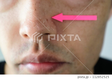 日焼けして皮が剥けた鼻 日焼けして皮が剥けた鼻 112852525