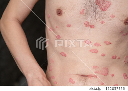 Psoriasis Vulgaris, skin patches are typically red, itchy, and scaly. Papules of chronic psoriasis vulgaris on male hand, back and body. Genetic immune disease. Detail of psoriatic skin disease  112857536
