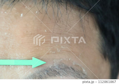 日焼けで剝けた肌 112861867