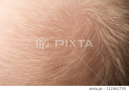 Macro shot of hair loss problem of blonde man hair closeup 112862730