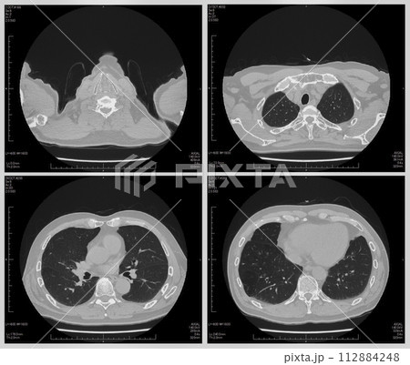 CT検査画像 112884248