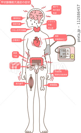 甲状腺機能亢進症の症状 112886457