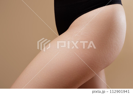 Close up female thighs with stretch marks. Stretch 112901941