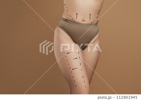 liposuction, fat and cellulite removal. Lifting liposuction, fat and cellulite removal. Lifting 112901945
