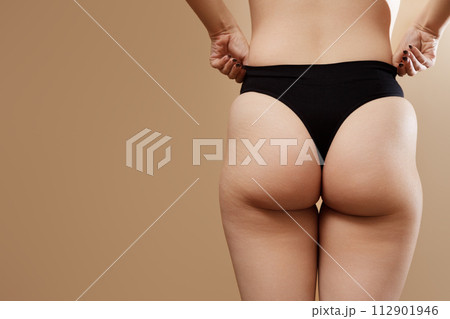 Close up female thighs with stretch marks. Stretch Close up female thighs with stretch marks. Stretch 112901946