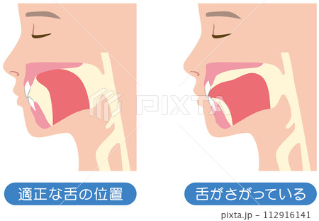 正しい舌の位置と下がっている舌の位置 112916141