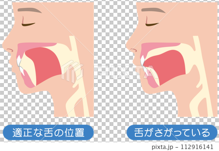 正しい舌の位置と下がっている舌の位置 112916141