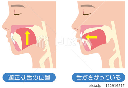 正しい舌の位置と下がっている舌の位置　ミューイング 112916215