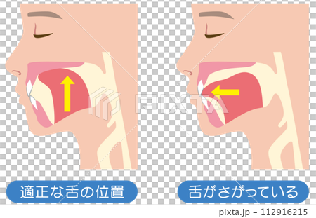 正しい舌の位置と下がっている舌の位置　ミューイング 112916215