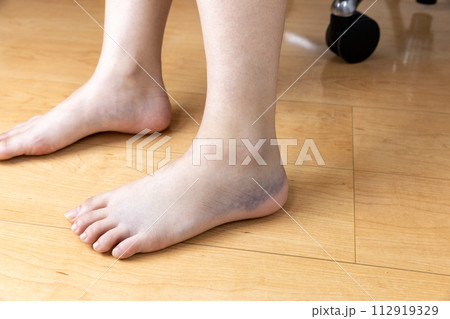 ねん挫した足首 112919329